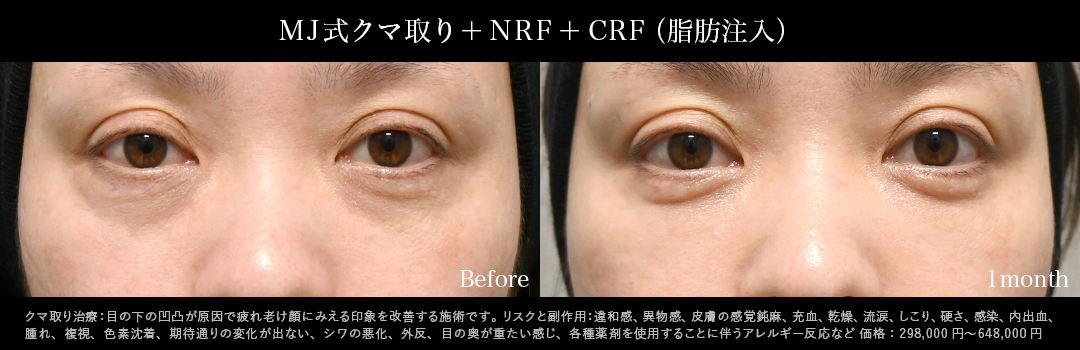 MJ式クマ取り+NRF+CRF症例