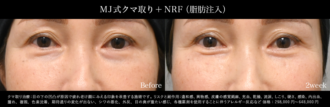 MJ式クマ取り+NRF症例