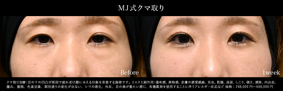 MJ式クマ取り単独症例