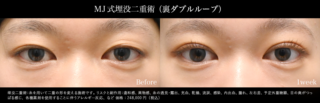 MJ式埋没二重術_裏ダブルループ症例