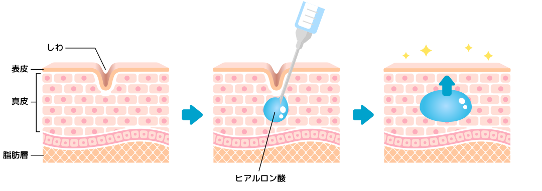 ヒアルロン酸_図
