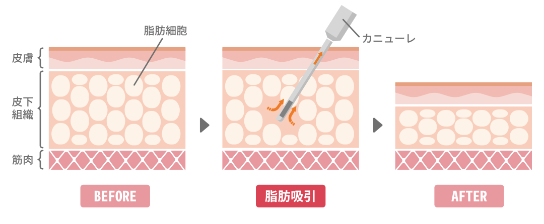 脂肪吸引_図