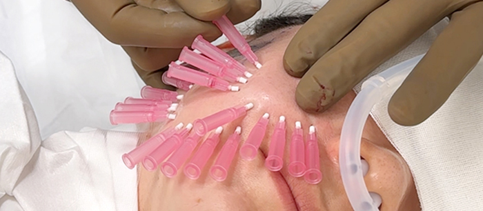 ショートスレッド