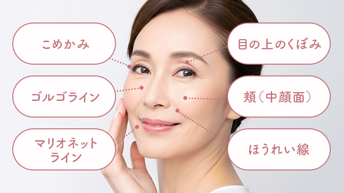 ヒアルロン酸注入部位_シワ・くぼみ・ボリューム補整