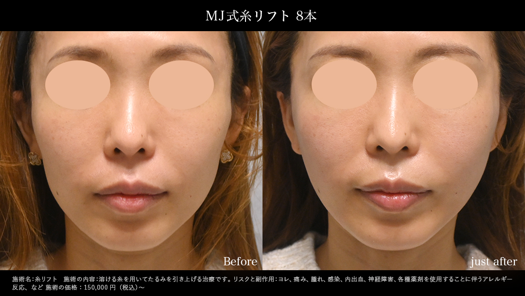 MJ式糸リフト_手術直後