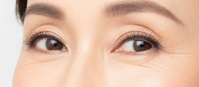 40代以降の埋没二重術