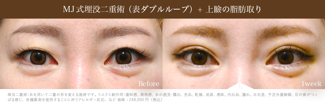 MJ式埋没二重術_表ダブルループ+上瞼の脂肪取り_1週間後