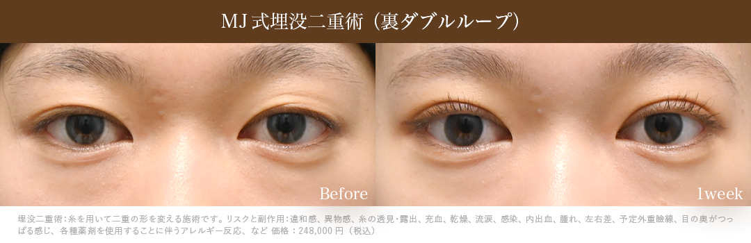 MJ式埋没二重術_裏ダブルループ_1週間