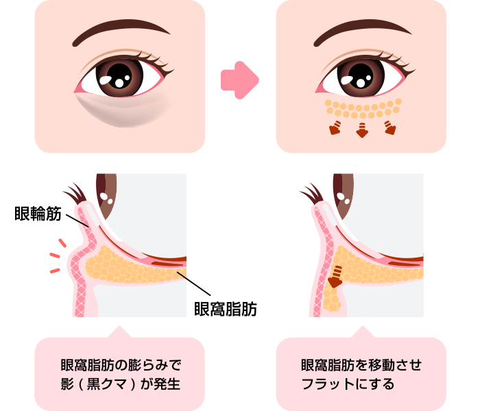 裏ハムラ_イラスト図