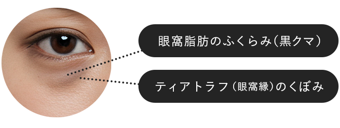 裏ハムラの適応タイプ