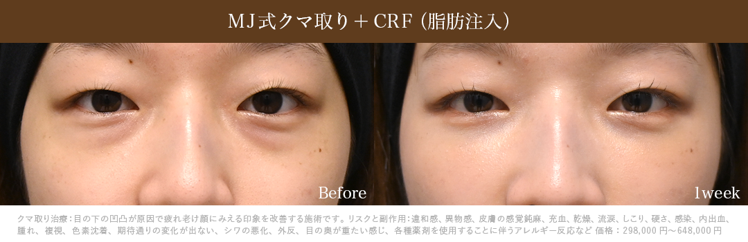 MJ式クマ取り+CRF症例_1週間後