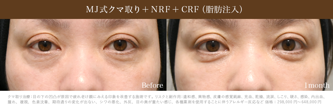 MJ式クマ取り+NRF+CRF症例_1ヶ月後
