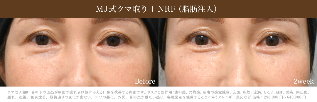 MJ式クマ取り+NRF症例_2週間後