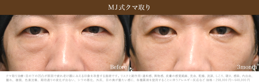 MJ式クマ取り単独症例_3ヶ月後