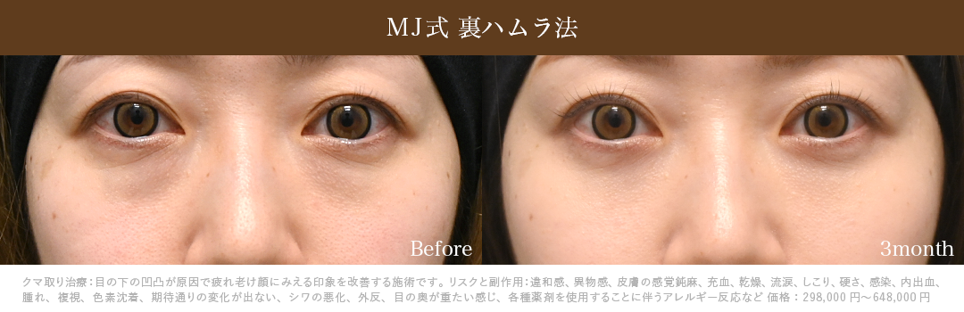 MJ式裏ハムラ症例_3ヶ月後