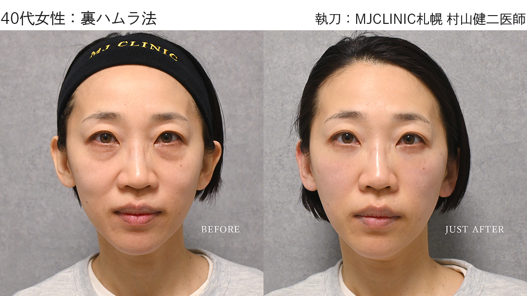 クマ取り_裏ハムラ全顔症例