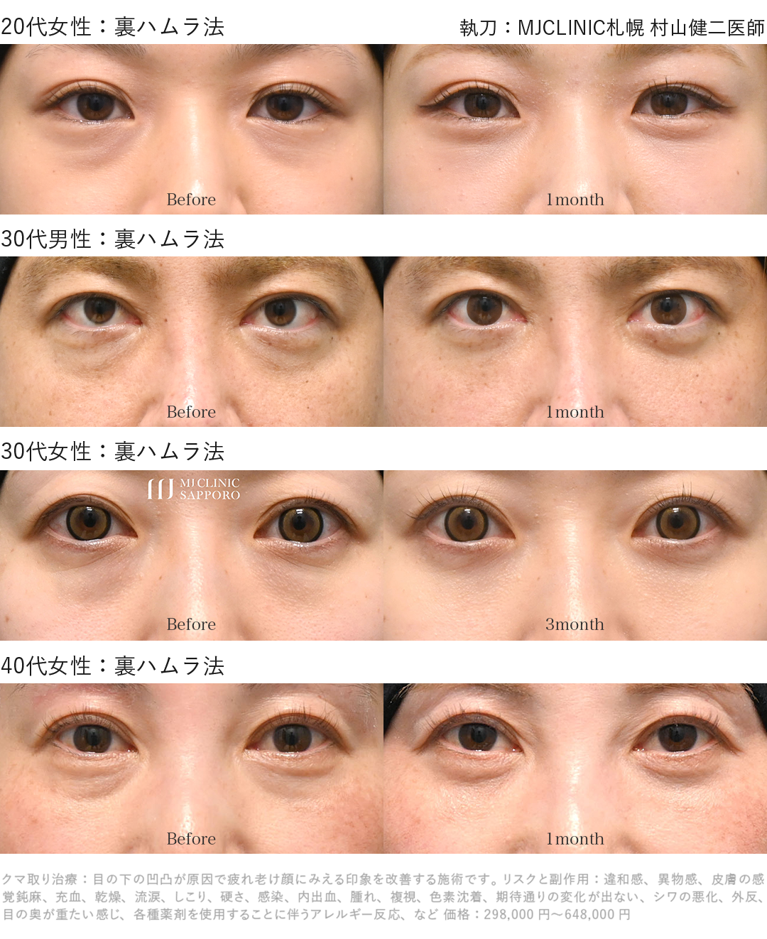 クマ取り_裏ハムラ症例