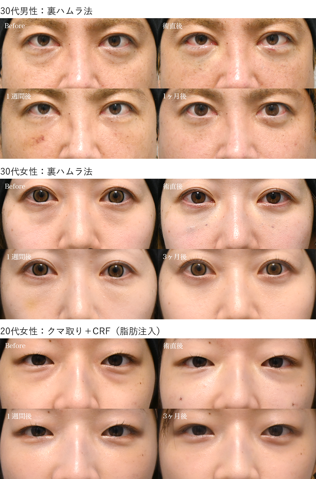 クマ取りダウンタイム症例_20代30代