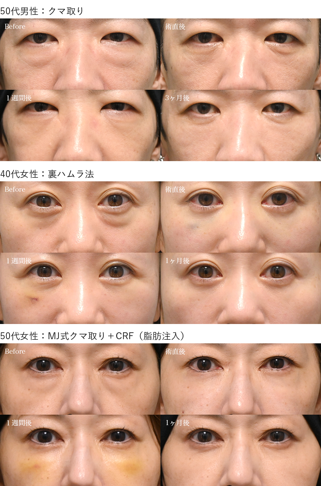 クマ取りダウンタイム症例_40代50代