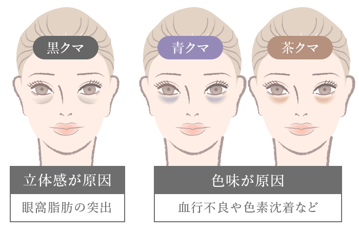 目の下のクマの種類