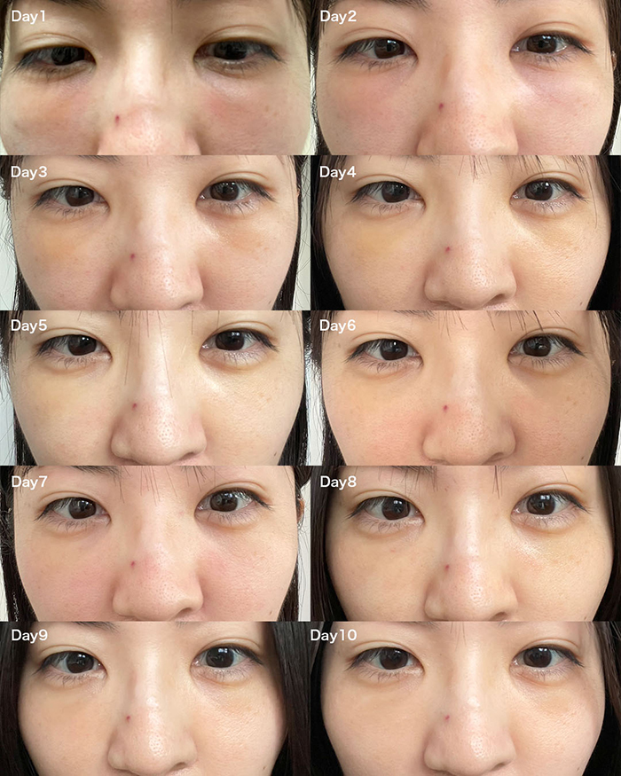 裏ハムラ_ダウンタイム経過