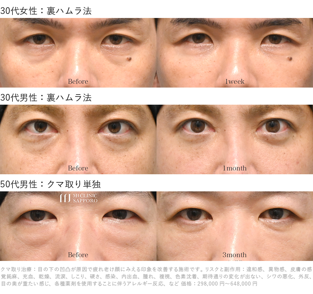 男性のクマ取り_クマ治療症例