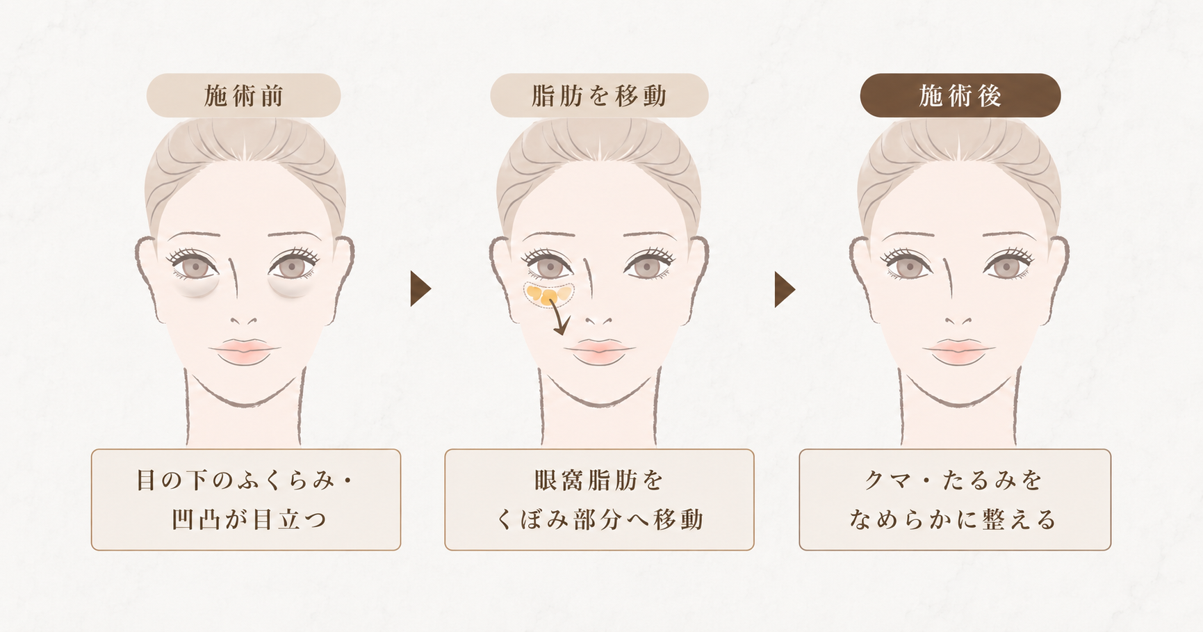 裏ハムラ法とは｜目の下のクマ・たるみの根本治療