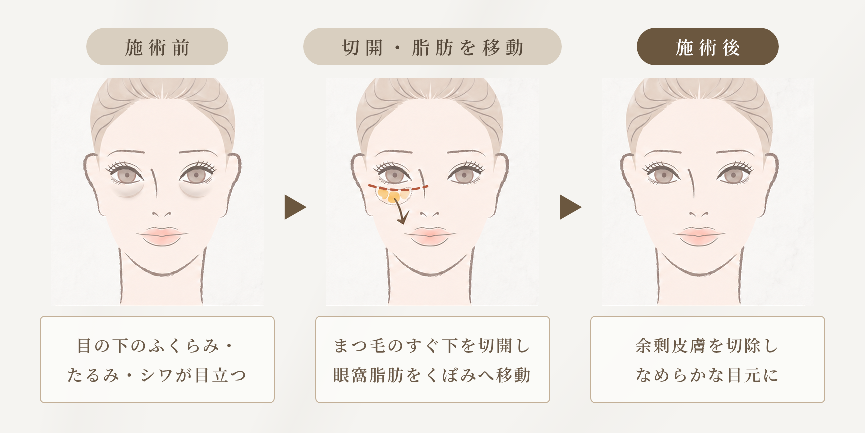 表ハムラ法の仕組み｜まつ毛のすぐ下を切開し眼窩脂肪をくぼみへ移動、余剰皮膚を切除してなめらかな目元に(札幌MJクリニック)